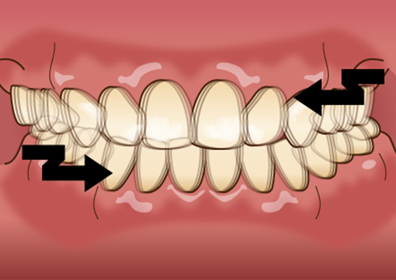 歯のこすり合わせ(グライディング)