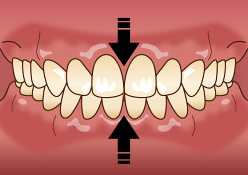 噛み合わせ|桶川市のくろさわ歯科ベニバナウォーク桶川医院