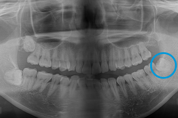 親知らずの抜歯症例